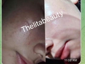 แค่แต้มสิวก็ยุบ หัวสิวหลุด หน้าขาวใส
